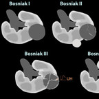 Renal Cysts bosniak-classification-renal-cysts Renal Cysts bosniak-classification-renal-cysts