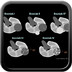 Renal Cysts bosniak-classification-renal-cysts