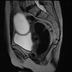 Masse kystique uniloculée en faveur d'une tumeur épithéliale bénigne, plus probablement de type séreux. Sagittal T2 Masse kystique uniloculée en faveur d'une tumeur épithéliale bénigne, plus probablement de type séreux. Sagittal T2