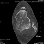 Ostéochondromatose Scanner Ostéochondromatose Scanner