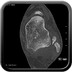 Ostéochondromatose Scanner