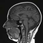 Kyste de la poche de Rathke IRM Sagittal T1 SE Kyste de la poche de Rathke IRM Sagittal T1 SE