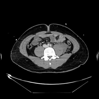 hernie diaphragmatique, traumatisme thoracique, traumatisme abdominal, burst fracture, fracture du pied abdomen portal axial