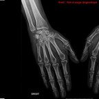 Tendinopathie calcifiante du Fléchisseur ulnaire du carpe Radiographie Membre supérieur J0 Tendinopathie calcifiante du Fléchisseur ulnaire du carpe Radiographie Membre supérieur J0