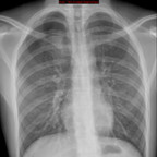 Pneumothorax droit sur blebs (bulle) Radiographie Thorax Face Pneumothorax droit sur blebs (bulle) Radiographie Thorax Face