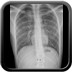 Pneumothorax droit sur blebs (bulle)  Radiographie Thorax Face