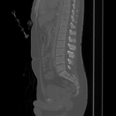 Traumatic diaphragmatic rupture, Thoracic and abdominal injuries, burst vertebral fracture, foot injuries Lumbar spine, Sagittal plane, Bone window