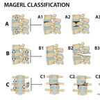 Thoracolumbar spine fractures Magerl-Classification-Thoracolumbar-spine-fractures Thoracolumbar spine fractures Magerl-Classification-Thoracolumbar-spine-fractures