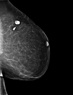 Récidive tardive de cancer du sein gauche 2-LML