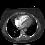 Embolie pulmonaire massive proximale avec des signes de gravité radiologiques. Axial Médiastin Embolie pulmonaire massive proximale avec des signes de gravité radiologiques. Axial Médiastin