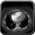 Embolie pulmonaire massive proximale avec des signes de gravité radiologiques. Axial Médiastin
