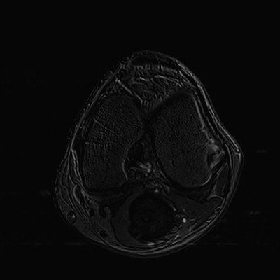 Anévrysme poplité thrombosé Soustraction