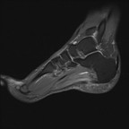 Aponévrosite plantaire Sagittal DP fat sat Aponévrosite plantaire Sagittal DP fat sat