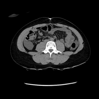 Abdominal vessels trauma, Intraperitoneal bladder rupture, Spleen infarction, Pelvic fracture Abdomen CT without injection