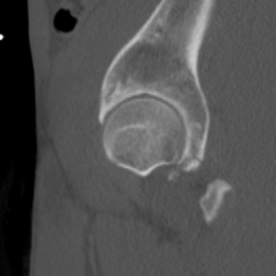 Thoracic Injuries, Subcapsular hemorrhage of liver, Pelvic injury Left hip, Sagittal plane, Bone window