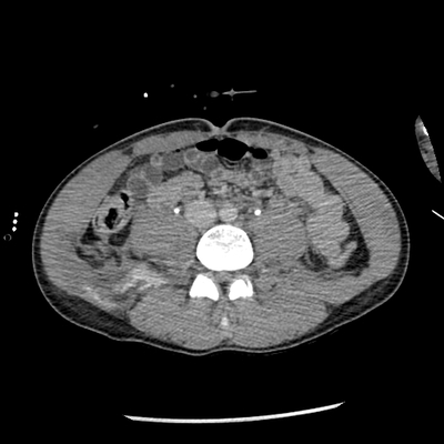 Cranioencephalic trauma, Facial fracture, Thoracic injuries, Pelvic fracture, Spleen and renal trauma Abdomen CT, Delayed phase, Axial plane