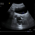 Kyste de la vésicule séminale et agénésie rénale homolatérale Echographie Pelvis Kyste de la vésicule séminale et agénésie rénale homolatérale Echographie Pelvis