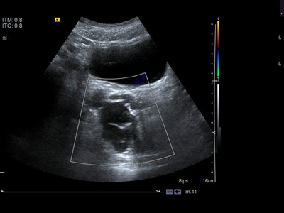 Kyste de la vésicule séminale et agénésie rénale homolatérale Echographie Pelvis