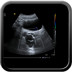 Kyste de la vésicule séminale et agénésie rénale homolatérale  Echographie Pelvis