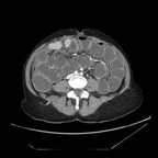 Occlusion colique mécanique sur néoplasie colique avec adénomégalies probablement envahies au contact Axial portal Occlusion colique mécanique sur néoplasie colique avec adénomégalies probablement envahies au contact Axial portal