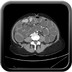 Occlusion colique mécanique sur néoplasie colique avec adénomégalies probablement envahies au contact Axial portal