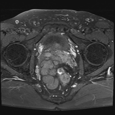 Kyste de la vésicule séminale et agénésie rénale homolatérale IRM Pelvis Axial T1 Gadolinium FS