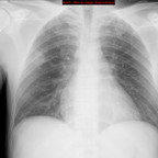 Pneumopathie excavée à Staphylocoque sur endocardite de la valve tricuspide Radiographie Thorax Face Pneumopathie excavée à Staphylocoque sur endocardite de la valve tricuspide Radiographie Thorax Face