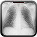 Pneumopathie excavée à Staphylocoque sur endocardite de la valve tricuspide  Radiographie Thorax Face