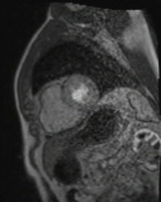 Dysplasie arythmogène du ventriule droit (DAVD) : critère majeur en IRM PERFUSION RespLib _dynamic_rest_MOCO