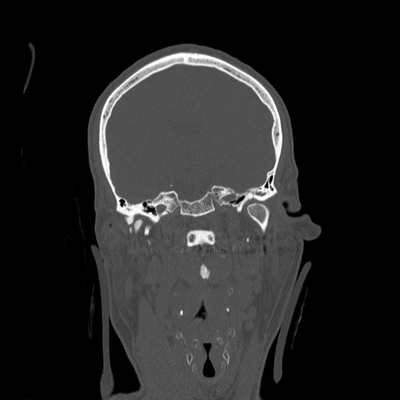 Subarachnoid Hemorrhage, Traumatic, Pneumothorax, Sternum fracture Head CT, Coronal plane, Bone window