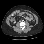 Péritonite aigue sur pyosalpinx aigu gauche TDM Abdomen Axial Temps veineux Péritonite aigue sur pyosalpinx aigu gauche TDM Abdomen Axial Temps veineux