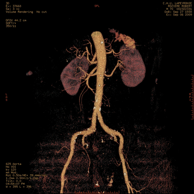 Hepatic fracture, Active hemorrhage Abdominal vessels 3D VR