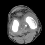 Fracture de l'extrémité inférieure de la patella Axial mou Fracture de l'extrémité inférieure de la patella Axial mou