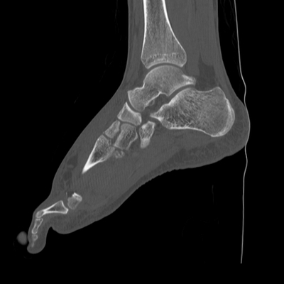 hernie diaphragmatique, traumatisme thoracique, traumatisme abdominal, burst fracture, fracture du pied pied gauche sag os