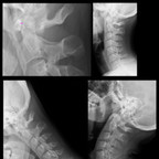 Atlantoaxial Subluxation/Dislocation Normal-atlantodental-distance-C1-C2 Atlantoaxial Subluxation/Dislocation Normal-atlantodental-distance-C1-C2