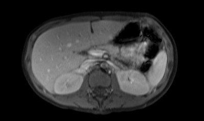 Phéochromocytome et paragangliome dans un contexte de maladie de Von Hippel Lindau ser011img00001