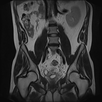 Kyste de la vésicule séminale et agénésie rénale homolatérale IRM Pelvis Abdomen Coronal T2