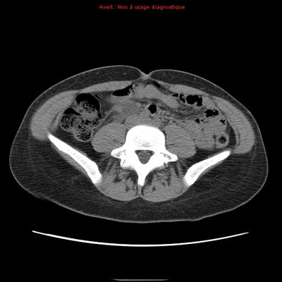 colique néphrétique droite sur calcul du méat urétéral  TDM Abdomen Pelvis Axial Sans injection