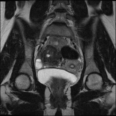 Volumineux fibrome sous-séreux pédiculé avec remaniements oedémateux Coronal T2