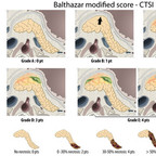Acute pancreatitis Balthazar-score-CTSI-acute-pancreatitis Acute pancreatitis Balthazar-score-CTSI-acute-pancreatitis