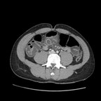 Peritonite sur Meckelite perforée. TDM Abdomen Axial Temps veineux Peritonite sur Meckelite perforée. TDM Abdomen Axial Temps veineux