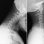 Entorse cervicale grave C4-C5 avec lésion disco-ligamentaire Radio profil Entorse cervicale grave C4-C5 avec lésion disco-ligamentaire Radio profil