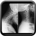Entorse cervicale grave C4-C5 avec lésion disco-ligamentaire Radio profil