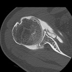 Desinsertion du tendon du muscle subscaulaire quasi complète. TDM Membre supérieur Axial Intra-articulaire Desinsertion du tendon du muscle subscaulaire quasi complète. TDM Membre supérieur Axial Intra-articulaire