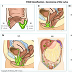 Carcinoma of the vulva FIGO-Classification-Carcinoma-of-the-vulva Carcinoma of the vulva FIGO-Classification-Carcinoma-of-the-vulva