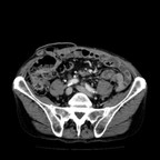 Pancréas annulaire associé à un carcinome urothélial métastatique. TDM Abdomen Axial Temps veineux Pancréas annulaire associé à un carcinome urothélial métastatique. TDM Abdomen Axial Temps veineux