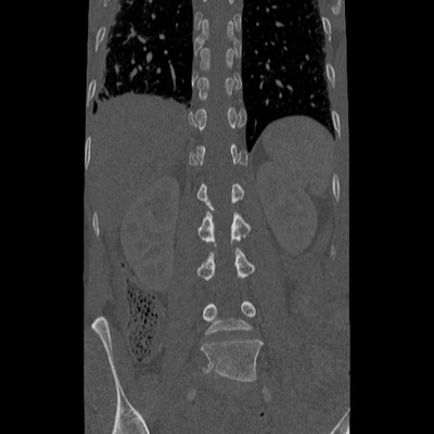 Traumatic perforation of small intestine, fracture of lumbar vertebra Lombar spine, Coronal plane, Bone window