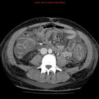pancolite à clostridium difficile TDM Abdomen Axial Fenêtre Tissus mous pancolite à clostridium difficile TDM Abdomen Axial Fenêtre Tissus mous