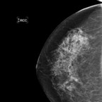 Carcinome canalaire infiltrant de grade SBR 2 1-RCC 2008 Carcinome canalaire infiltrant de grade SBR 2 1-RCC 2008