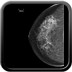 Carcinome canalaire infiltrant de grade SBR 2 1-RCC 2008